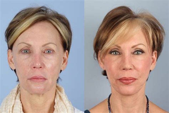 Actress Edie Falco’s Botox And Facelift, Why The Sopranos’ Fans Think She Has Done Plastic Surgery?