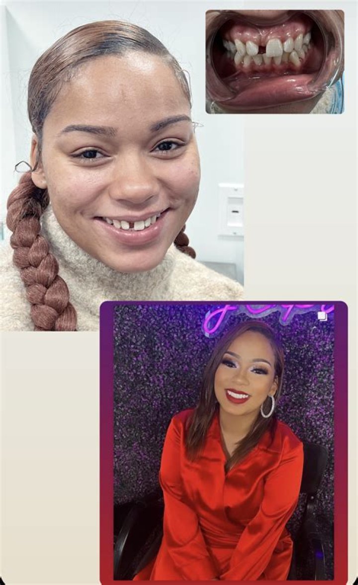 Cardi B’s New Teeth Costs $40k – Before and After Pictures of Smile Makeover | Dr. Catrise Austin is The Dentist