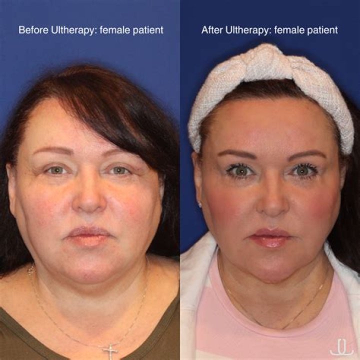 Discover The Benefits Of Ultherapy In Lehigh Valley