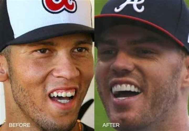 Does Freddie Freeman Have Fake Teeth? Before And After Pictures Suggests He At Least Has Veneers