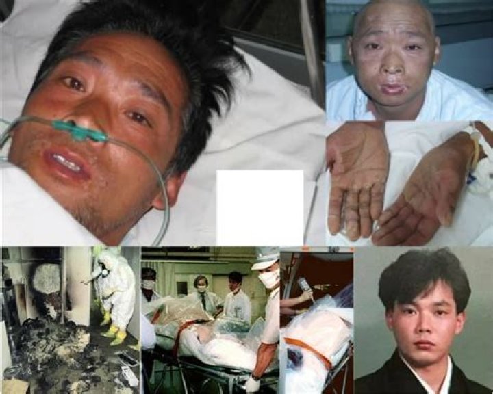 Hisashi Ouchi Body: Real Photos Of Japanese Nuclear Plant Worker Kept Alive Melted for 83 Days
