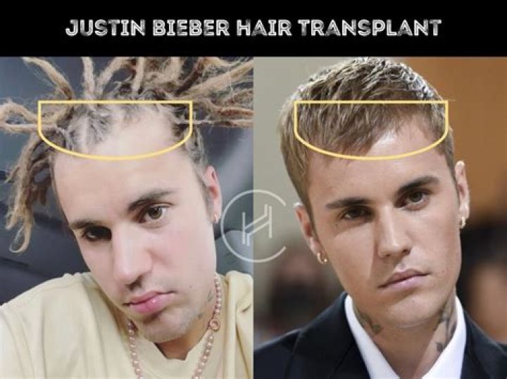 Understanding Justin Bieber's Hair Loss Journey