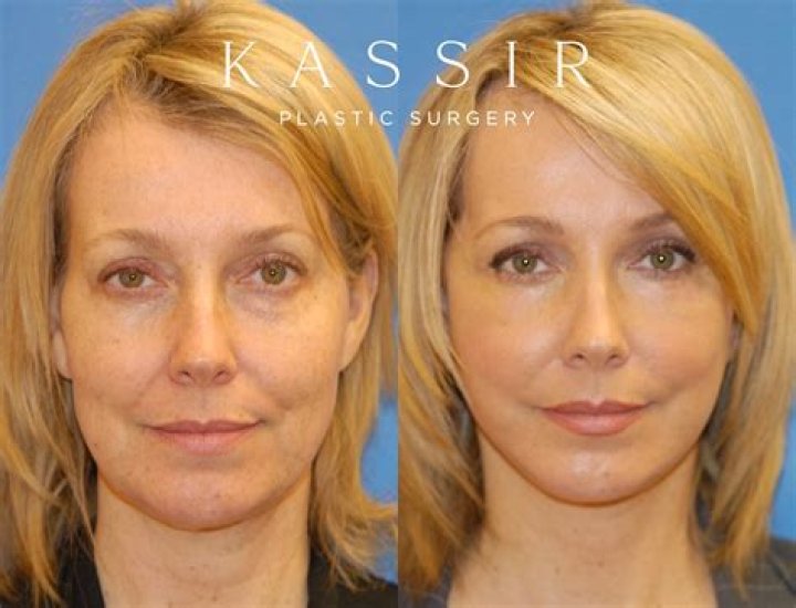 What Happened To Laura Ingraham Face? Face Lift and Plastic Surgery Update